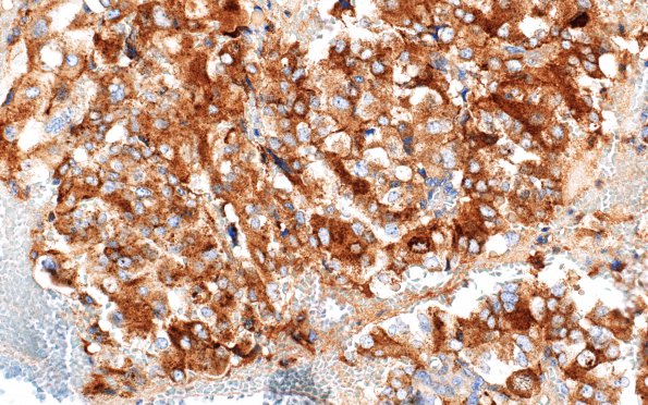 4E2 Choroid Plexus Carcinoma (Case 4) Transthyretin 6