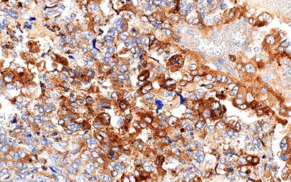 4E3 Choroid Plexus Carcinoma (Case 4) Transthyretin 7