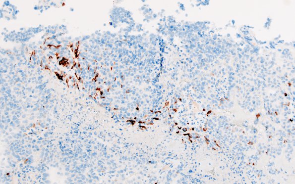 4F Choroid Plexus Carcinoma (Case 4) GFAP 20X