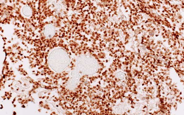 4G2 Choroid Plexus Carcinoma (Case 4) INI1 3