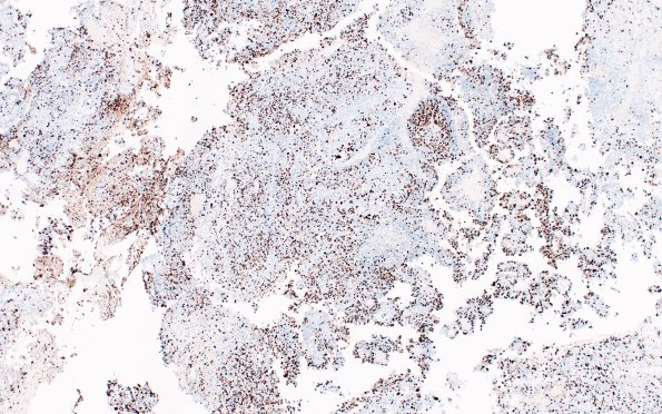 4H1 Choroid Plexus Carcinoma (Case 4) Ki67 1