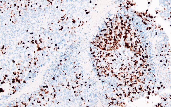 4H2 Choroid Plexus Carcinoma (Case 4) Ki67 2