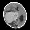 5A1 CPC (Case 5) CT scan wo Contrast - Copy