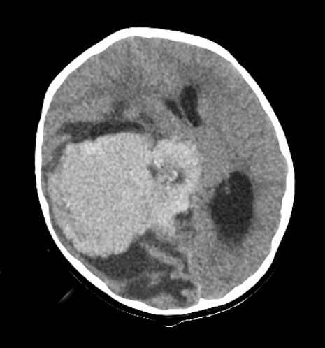 5A1 CPC (Case 5) CT scan wo Contrast - Copy