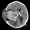 5A2 CPC (Case 5) CT scan - Copy