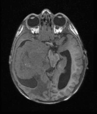 5A4 CPC (Case 5) T1 - Copy