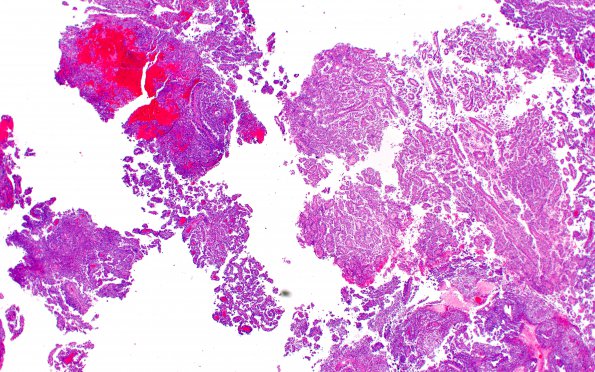 5B1 CPC (Case 5) H&E 2