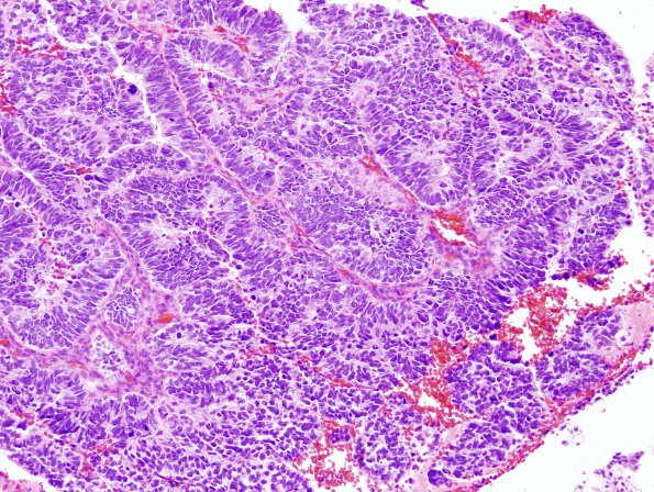 6A1 Choroid Plexus Carcinoma (Case 6)