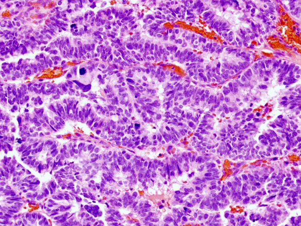 6A2 Choroid Plexus Carcinoma (Case 6) 2