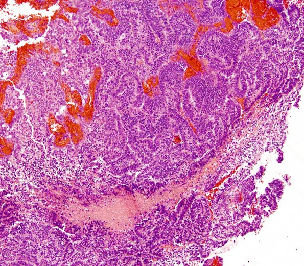 6A3 Choroid Plexus Carcinoma (Case 6) 4