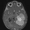 7A1 Choroid Plexus Carcinoma (Case 7) T1 W 1 - Copy