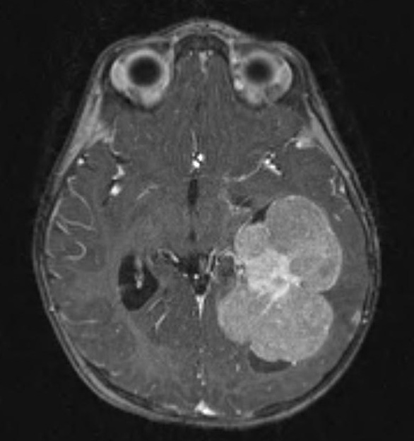 7A1 Choroid Plexus Carcinoma (Case 7) T1 W 1 - Copy