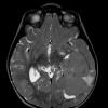 7A2 Choroid Plexus Carcinoma (Case 7) T2 W 1 - Copy