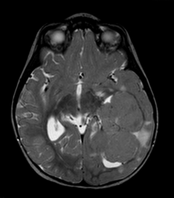 7A2 Choroid Plexus Carcinoma (Case 7) T2 W 1 - Copy