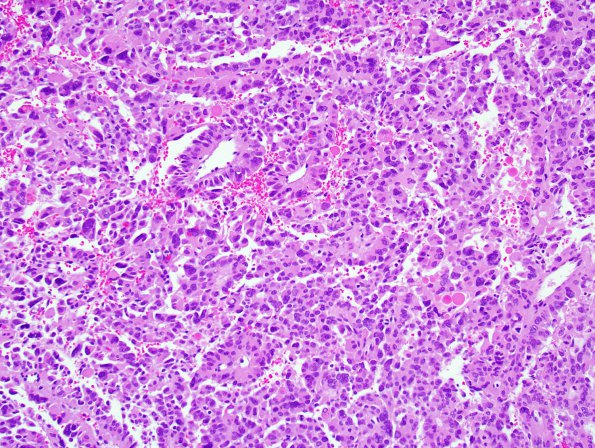 7B2 Choroid Plexus Carcinoma (Case 7) 2.jpg