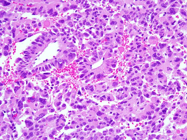 7B3 Choroid Plexus Carcinoma (Case 7) 3.jpg