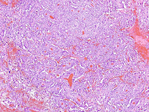 7B4 Choroid Plexus Carcinoma (Case 7) H&E 2