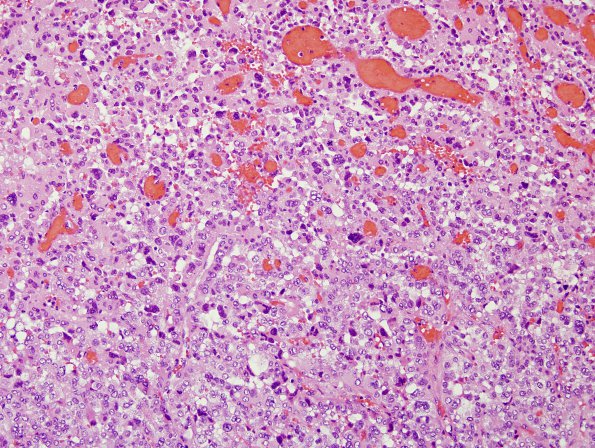 7B5 Choroid Plexus Carcinoma (Case 7) H&E 7