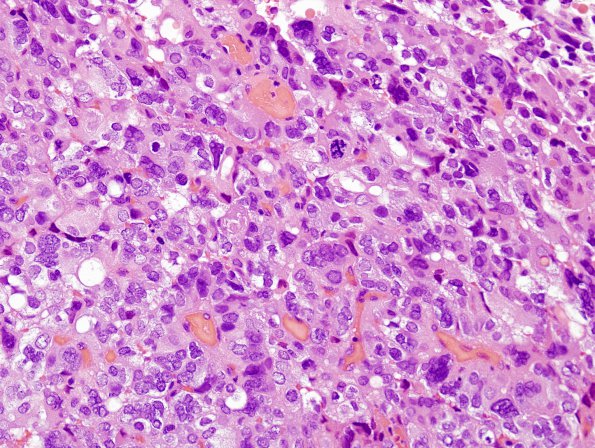 7B6 Choroid Plexus Carcinoma (Case 7) H&E 6