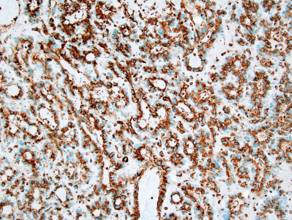 7C1 Choroid Plexus Carcinoma (Case 7) VIM 1A