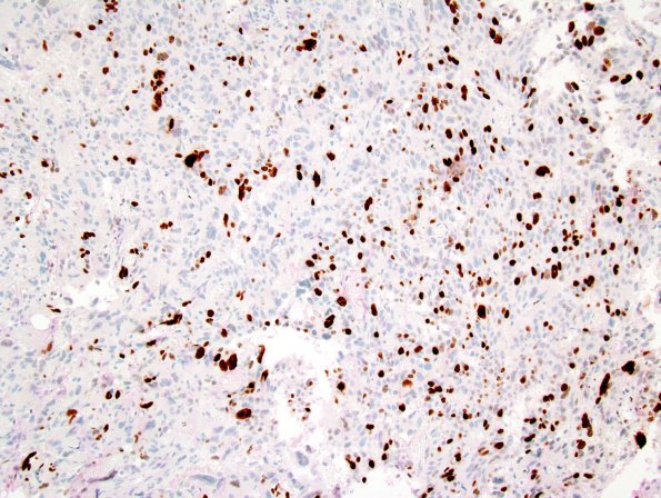 7E1 Choroid Plexus Carcinoma (Case 7) Ki-67 1.jpg