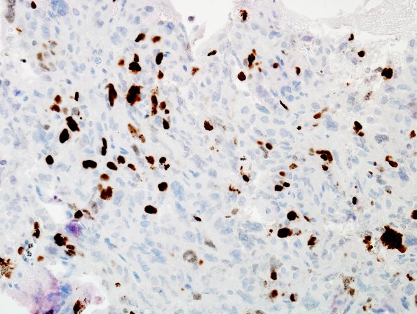 7E2 Choroid Plexus Carcinoma (Case 7) MIB