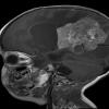 8A1 Choroid Plexus Carcinoma (Case 8) T1 W 2 - Copy