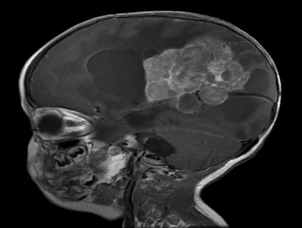 8A1 Choroid Plexus Carcinoma (Case 8) T1 W 2 - Copy