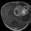 8A2 Choroid Plexus Carcinoma (Case 8) T1 W 1A - Copy