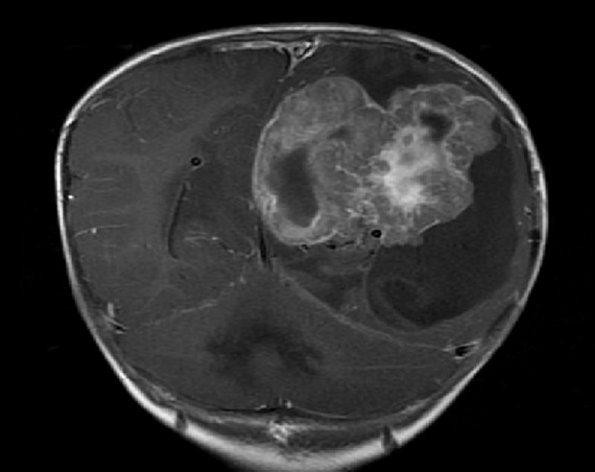 8A2 Choroid Plexus Carcinoma (Case 8) T1 W 1A - Copy