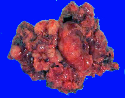 8B Choroid Plexus Carcinoma (Case 8) Gross