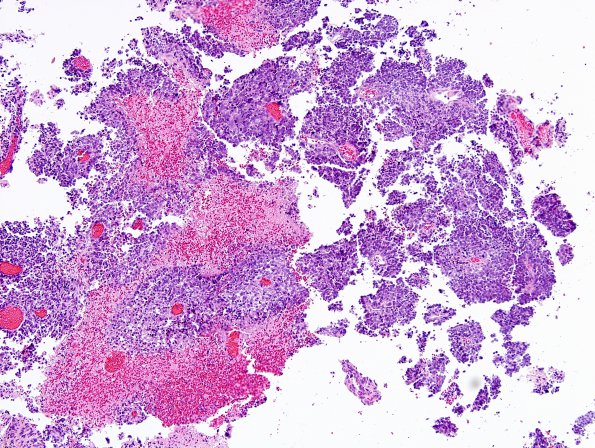 8C1 Choroid Plexus Carcinoma (Case 8) H&E 21