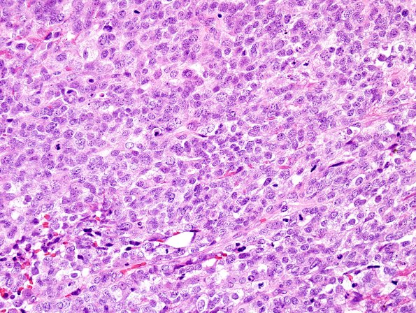 8C2 Choroid Plexus Carcinoma (Case 8) H&E 10