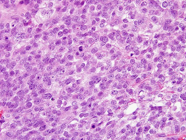 8C3 Choroid Plexus Carcinoma (Case 8) H&E 2