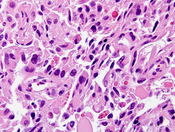 8C4 Choroid Plexus Carcinoma (Case 8) H&E 7