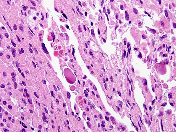 8C5 Choroid Plexus Carcinoma (Case 8) H&E 9