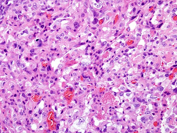 8C6 Choroid Plexus Carcinoma (Case 8) H&E 26