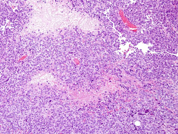 8C7 Choroid Plexus Carcinoma (Case 8) H&E 16