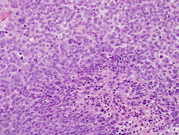 8C8 Choroid Plexus Carcinoma (Case 8) H&E 27