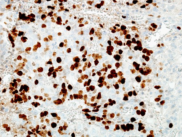 8D2 Choroid Plexus Carcinoma (Case 8) Ki67 2.