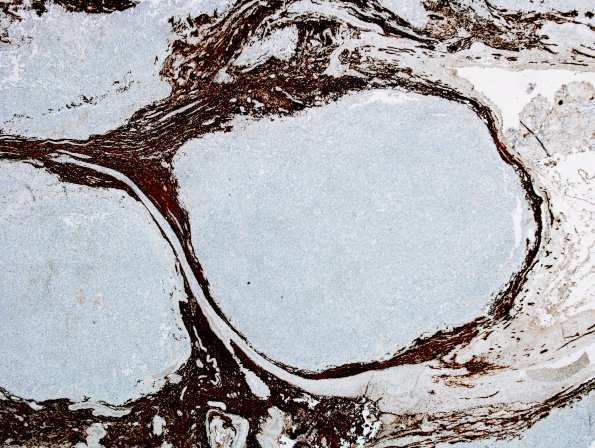 8E Choroid Plexus Carcinoma (Case 8) GFAP.