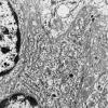 8F Choroid Plexus Carcinoma (Case 8) EM