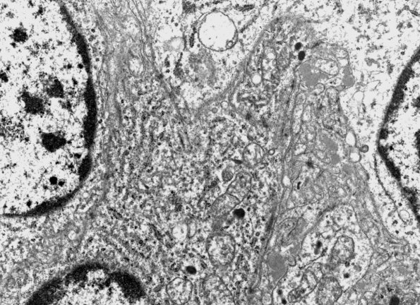 8F Choroid Plexus Carcinoma (Case 8) EM