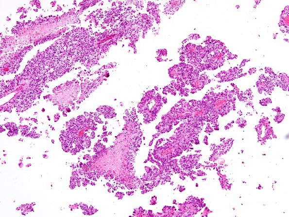 9A1 Choroid Plexus Carcinoma (Case 9) H&E 10