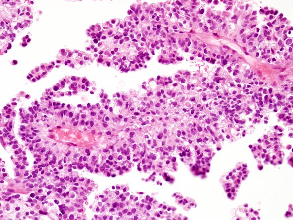 9A2 Choroid Plexus Carcinoma (Case 9) H&E 7ap.jpg