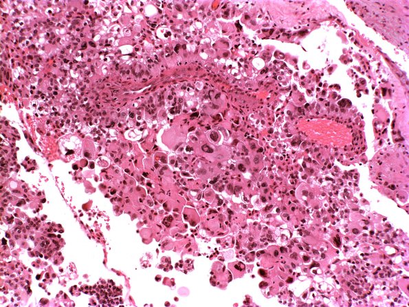 9A3 Choroid Plexus Carcinoma (Case 9) b