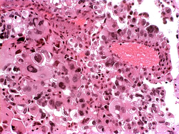 9A4 Choroid Plexus Carcinoma (Case 9) a