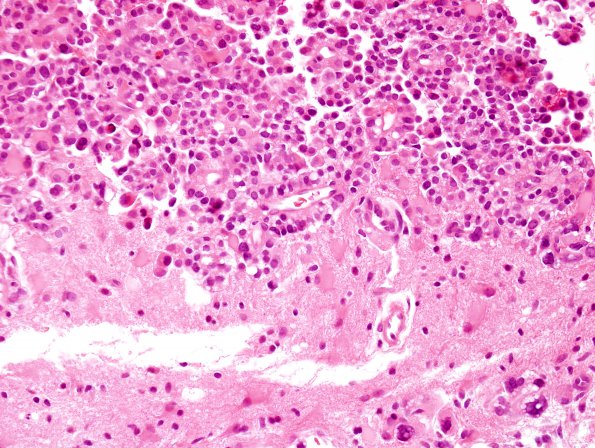 9A5 Choroid Plexus Carcinoma (Case 9) H&E 11