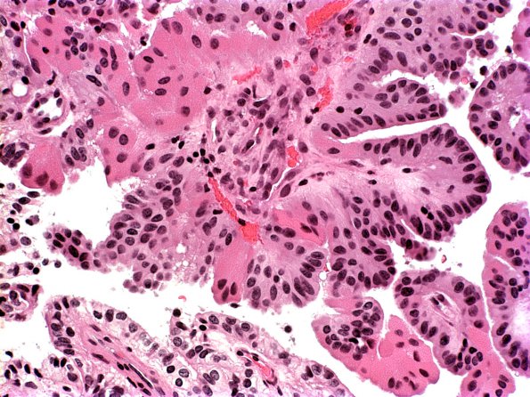 10A Choroid Plexus Papilloma (Case 10) B