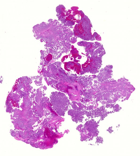 11A1 Choroid Plexus Papilloma with anaplasia (Case 11) H&E WM